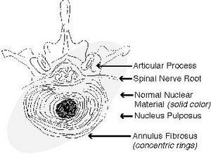 Normal intervertebral disc.