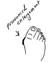 Illustration showing the pathology of sugar toes.