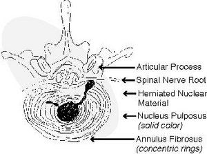 Herniated lumbar disc.