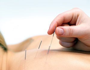 acupuncture