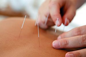 acupuncture needling