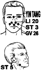 Acupuncture points on the face for treating chronic pain.