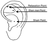 Anatomical locations of the shen men, relaxation and sham acupoints.