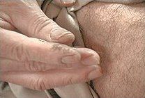 Acupuncture needle being inserted.