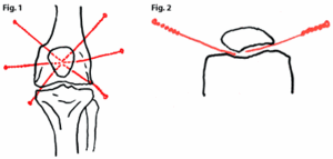 Insertion of acupuncture needles for the treatment of chondromalacia patellae.
