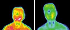 Infrared images for diabetes subject