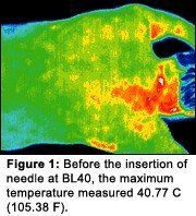 Infrared image #1 of upper back pain.