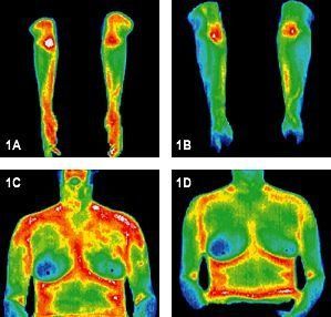 Infrared images of arms and torso before and after treatment.