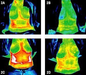 Infrared images of two torsos before and after treatment.