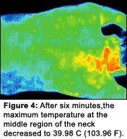 Infrared image #4 of upper back pain.