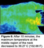 Infrared image #6 of upper back pain.