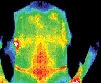 Infrared image of patient before treatment by acupuncture.