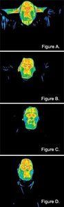 Infrared pictures of an acuppressure patient.