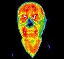 Infrared image of acupuncture patient.