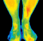 Infared image of lower legs and feet.