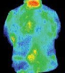 Infrared image of patient after treatment by acupuncture.