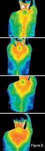 Infrared pictures of an acupressure patient.