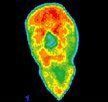 Infrared image of acupuncture patient.