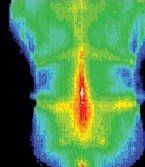 Infrared image of patient before treatment by acupuncture.