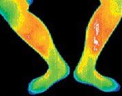 Thermogram of the inside of the left leg of a woman with liver cancer.