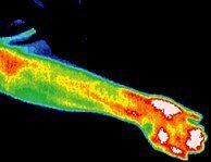 Infrared image of acupuncture patient.
