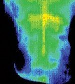 Infrared image of patient after being treated with electroacupuncture.