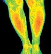 Thermogram of a woman with a digestive problem.