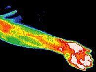 Infrared image of acupuncture patient.