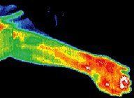 Infrared image of acupuncture patient.