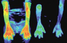 Infrared images of a woman with arthritis.