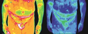 Infrared images of a male with prostate cancer.