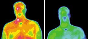 Infrared images for migraine patient