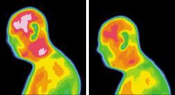 Infrared images for subject brain tumor