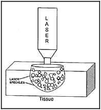 Illustration showing laser penatrating tissue.