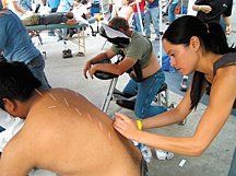 acupuncture