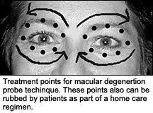 Treatment points for macular degeneration probe technique.