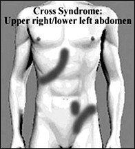 Illustration of Cross Syndrome.