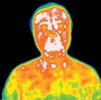 Infrared picture of a patient before acupuncture treatment.