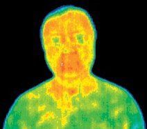 Infrared picture of a patient after first acupuncture treatment.