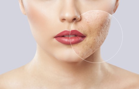 Microneedling for Acne / Acne Scars