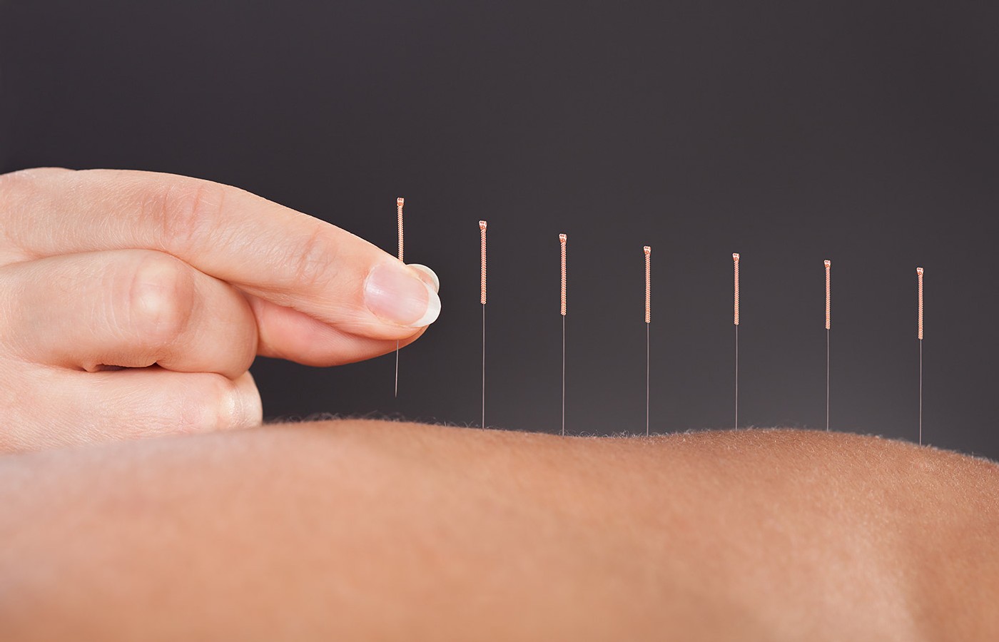 Will This Study Convince Medicare of Acupuncturists’ Value?